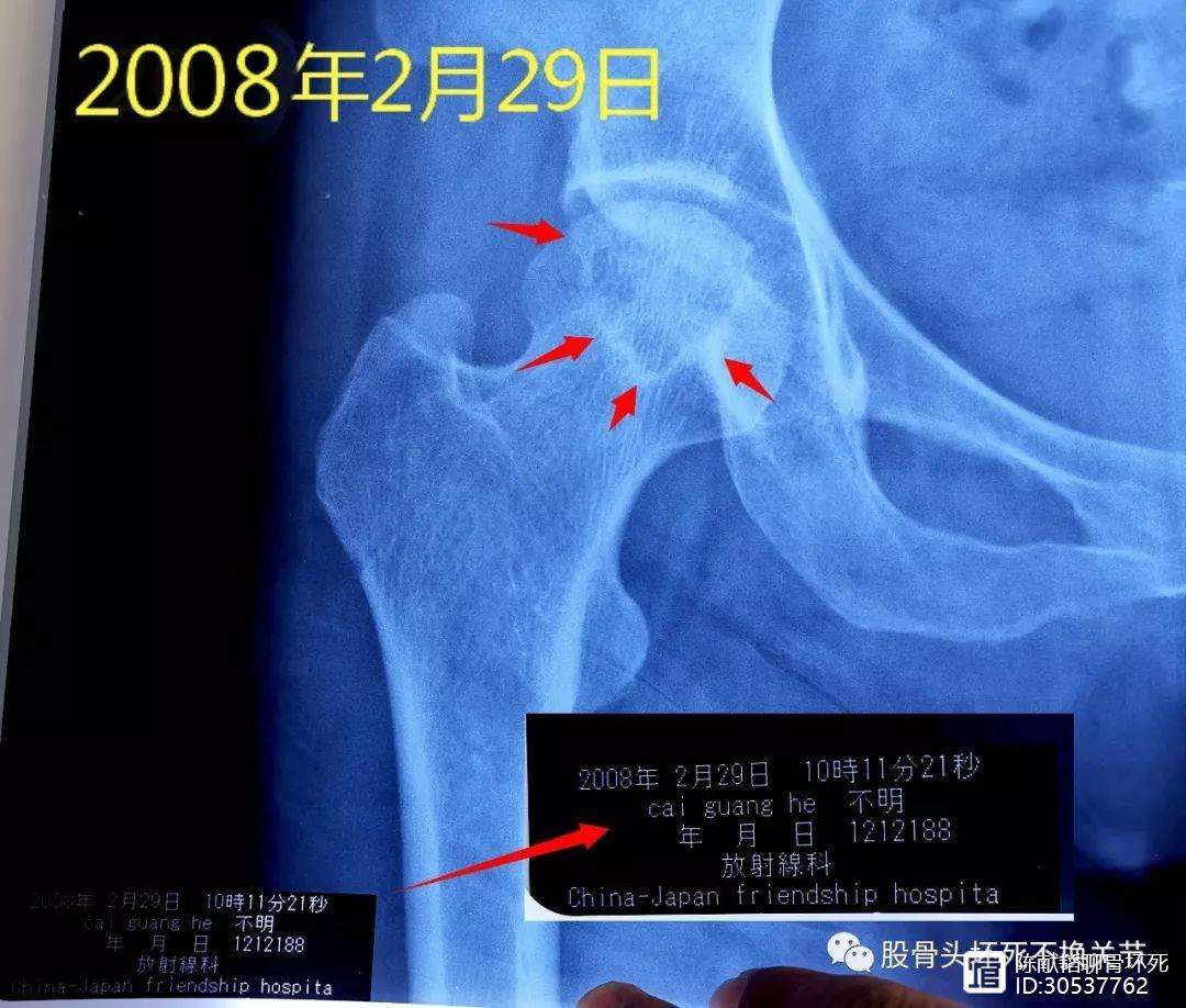 人工骨头医保报销多少(人工骨头医保报销多少比例)